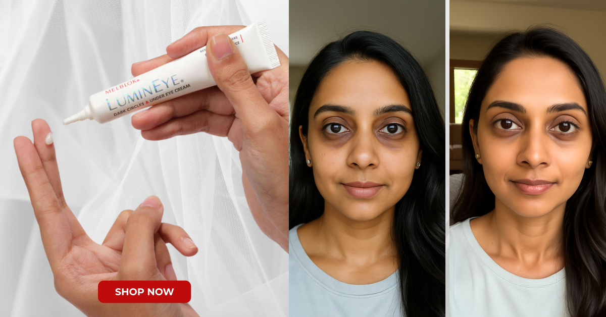 Sakshi’s Melblok LuminEye Results | Dark Circles Reduced Naturally
